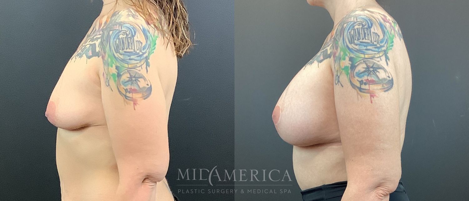Breast Augmentation & Lift Before & After