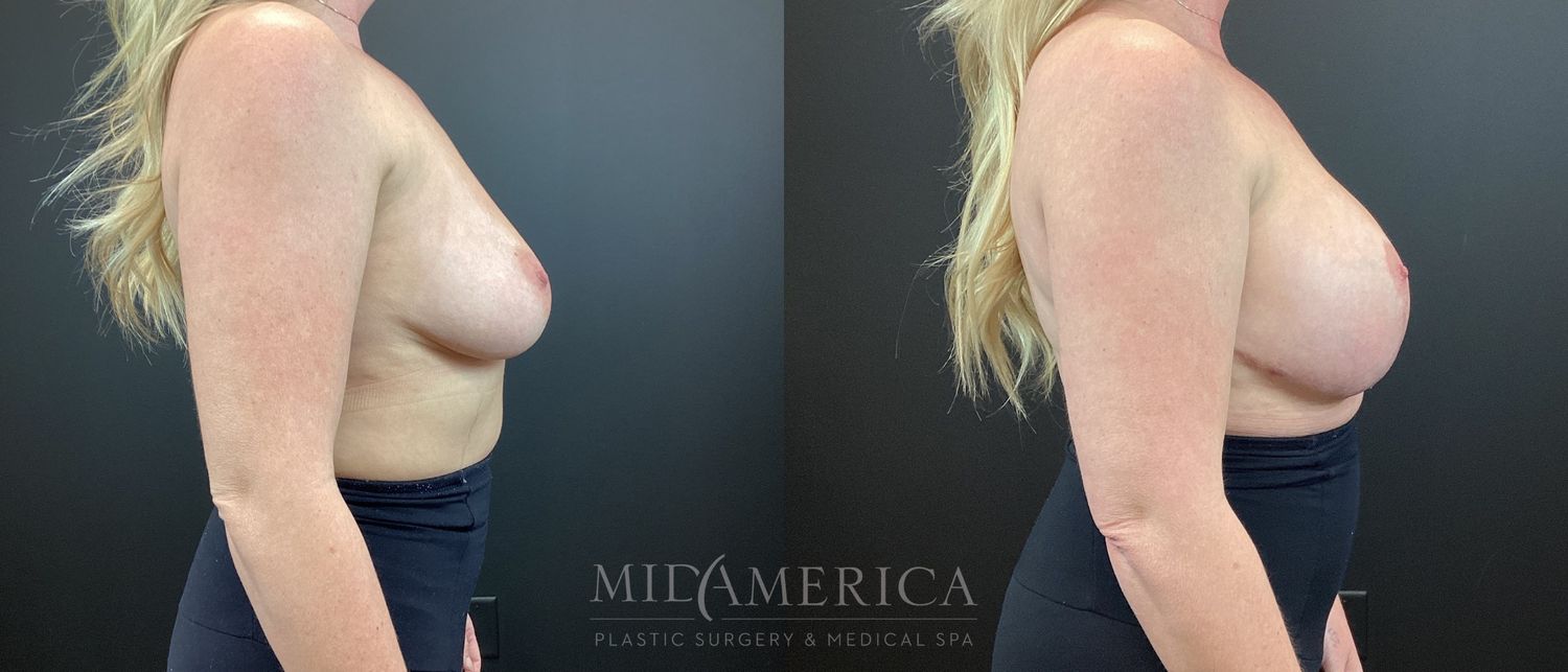 Breast Augmentation & Lift Before & After