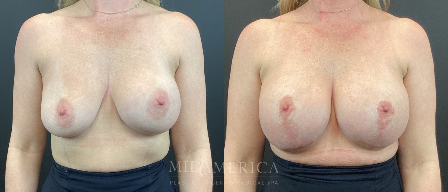 Breast Augmentation & Lift Before & After