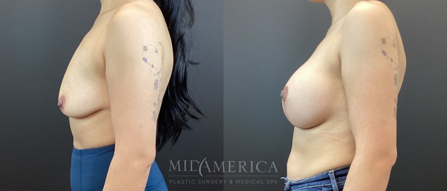 Breast Augmentation & Lift Before & After