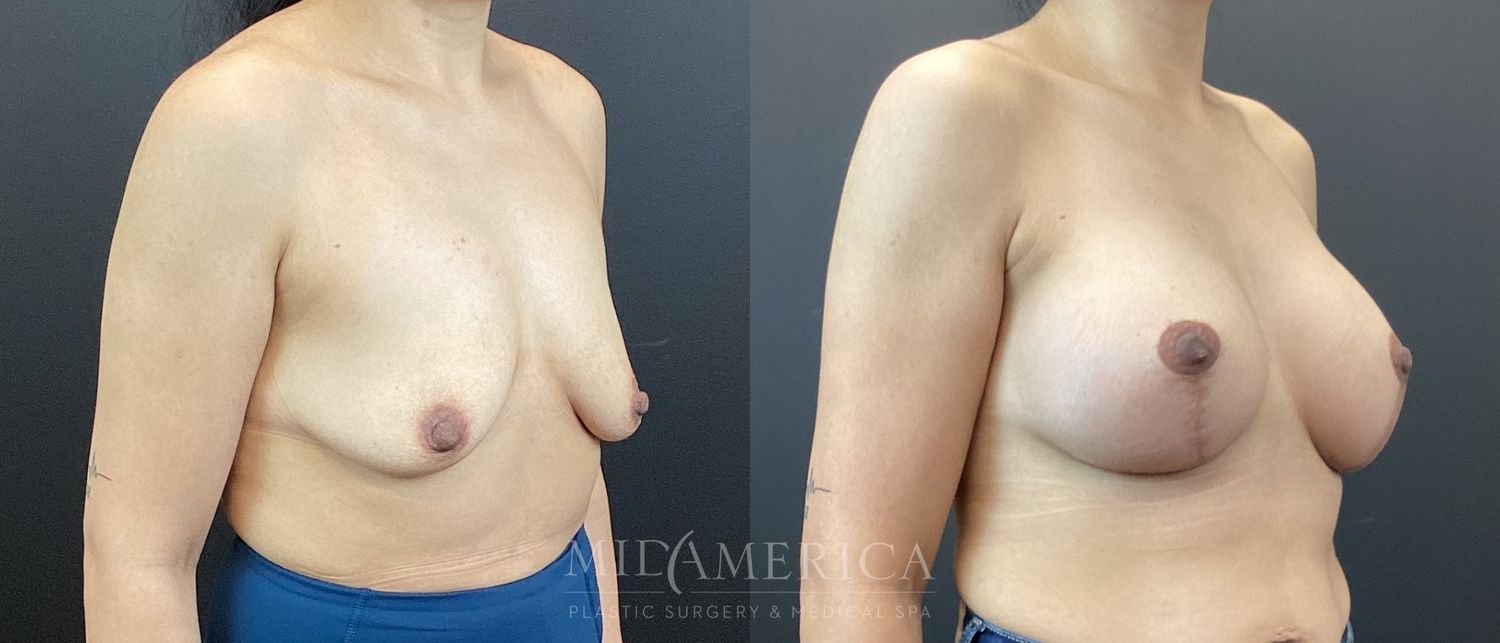 Breast Augmentation & Lift Before & After
