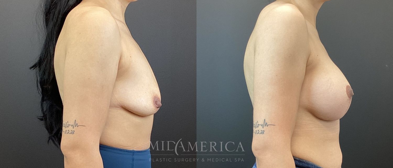 Breast Augmentation & Lift Before & After