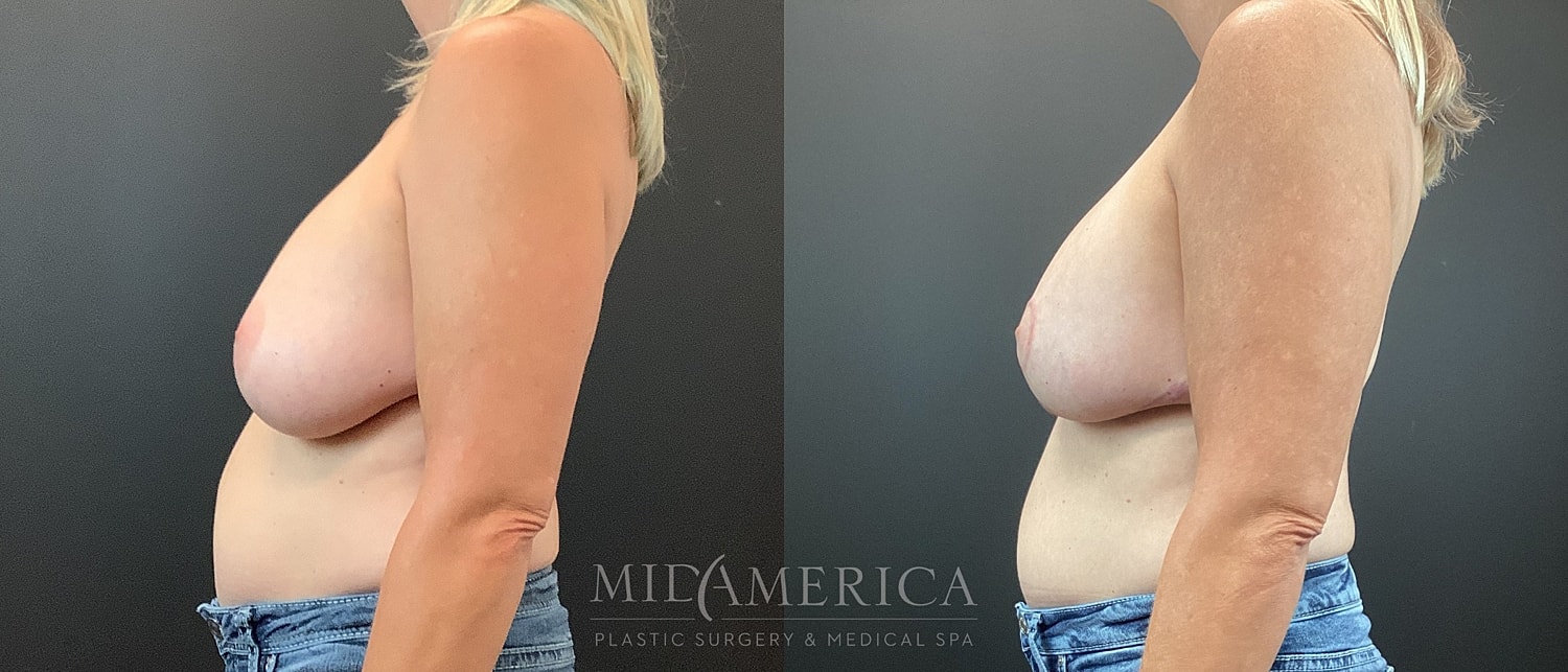 Breast Augmentation & Lift Before & After