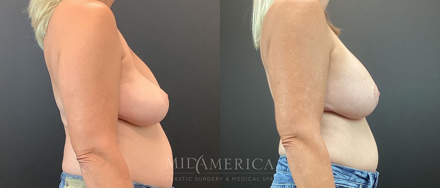 Breast Augmentation & Lift Before & After