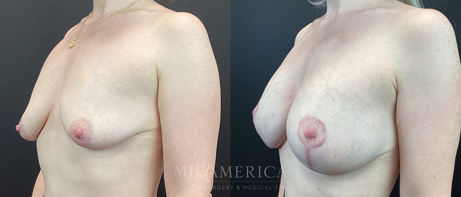 Breast Augmentation & Lift Before & After