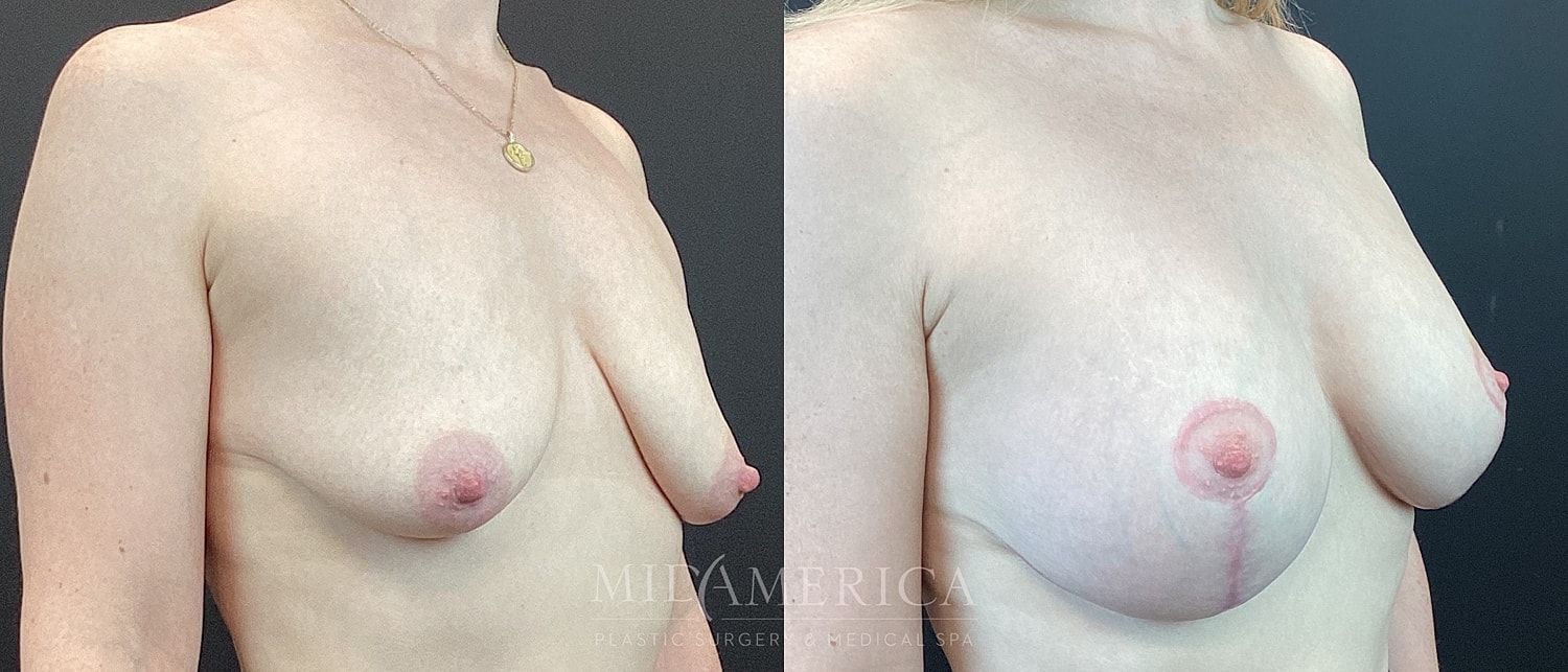 Breast Augmentation & Lift Before & After