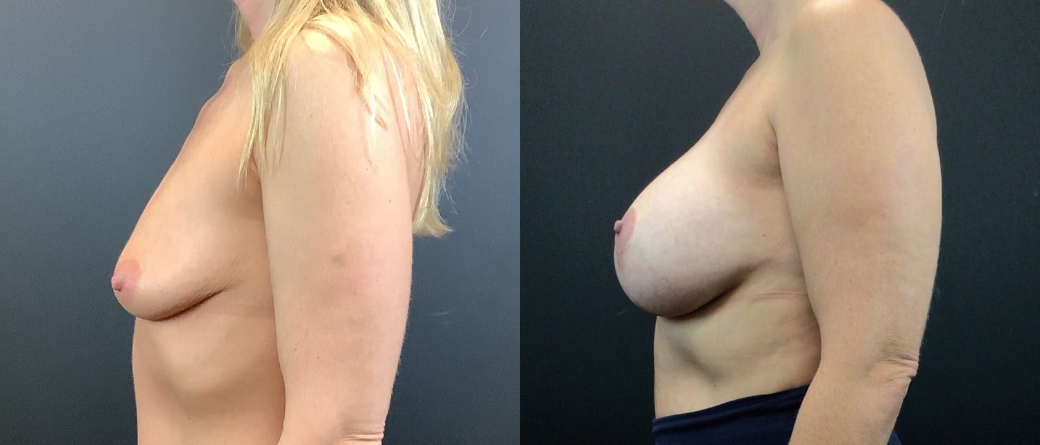 Breast Augmentation & Lift Before & After