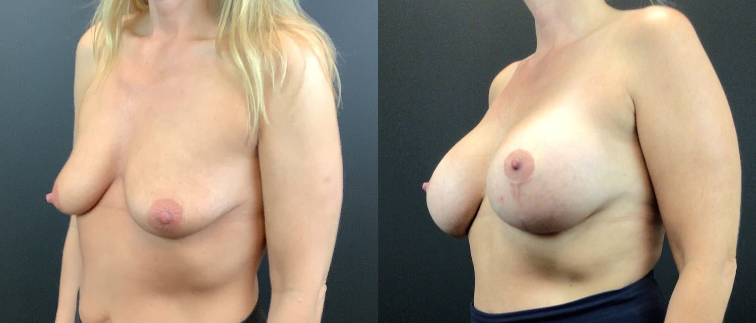 Breast Augmentation & Lift Before & After
