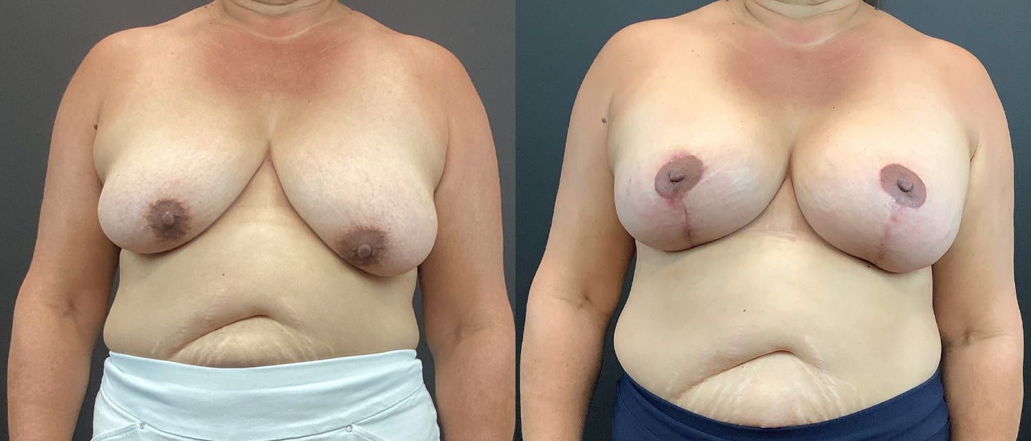 Breast Augmentation & Lift Before & After