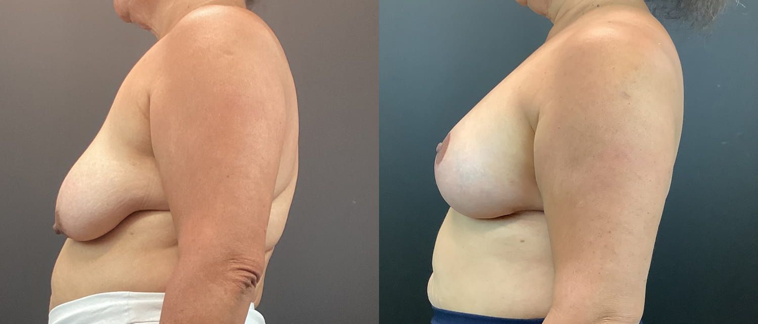 Breast Augmentation & Lift Before & After