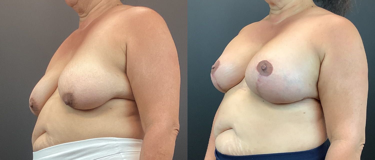 Breast Augmentation & Lift Before & After