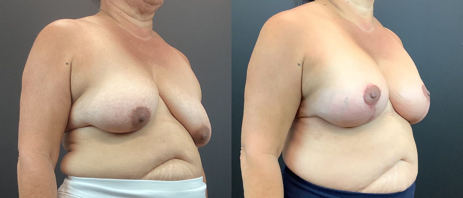 Breast Augmentation & Lift Before & After