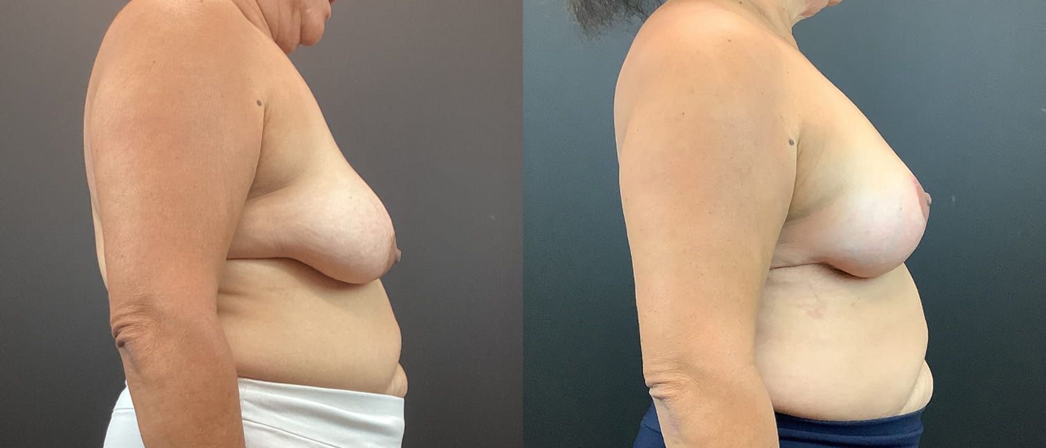 Breast Augmentation & Lift Before & After