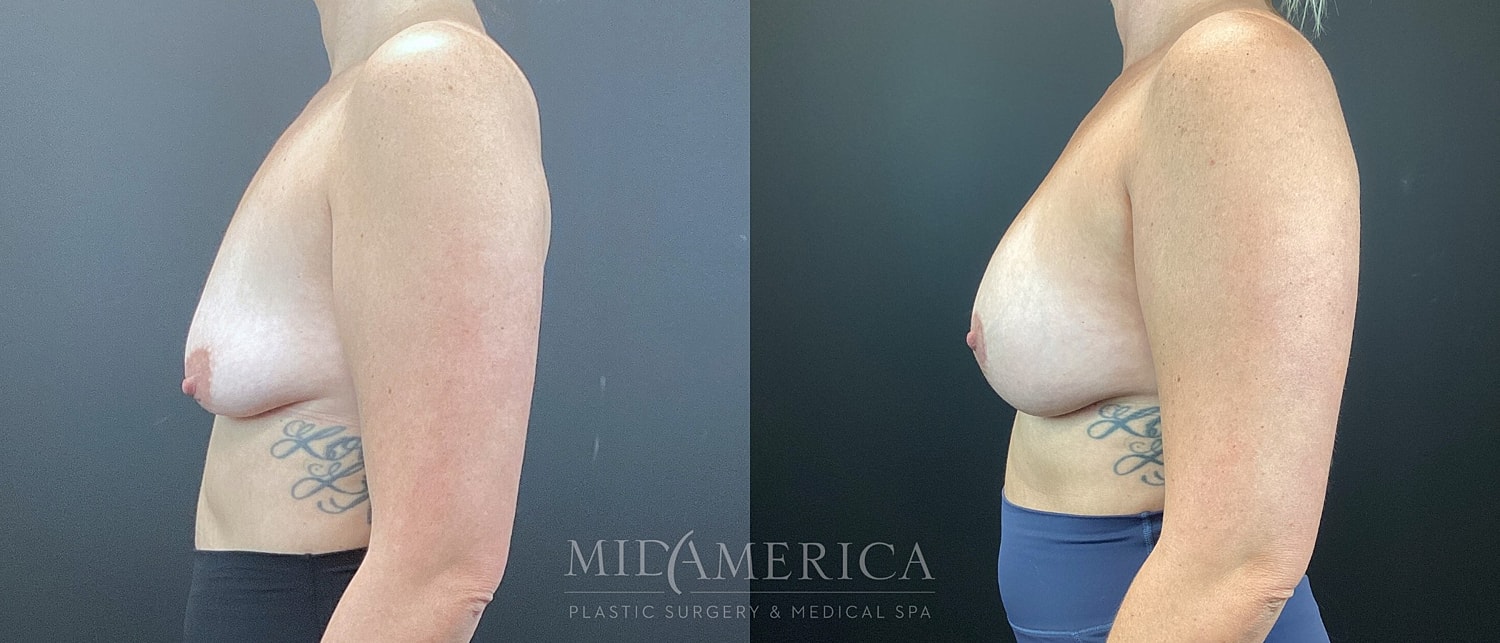 Breast Augmentation & Lift Before & After