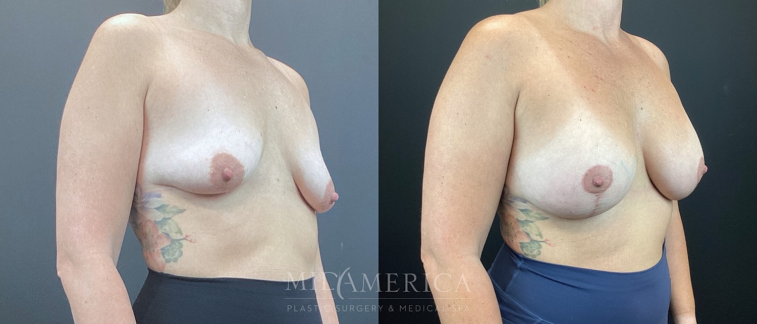 Breast Augmentation & Lift Before & After