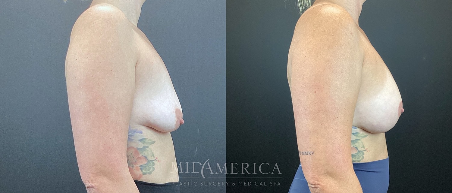 Breast Augmentation & Lift Before & After