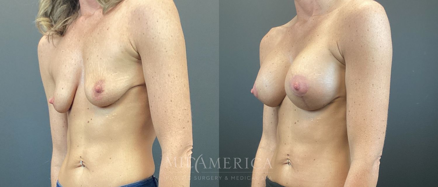 Breast Augmentation & Lift Before & After