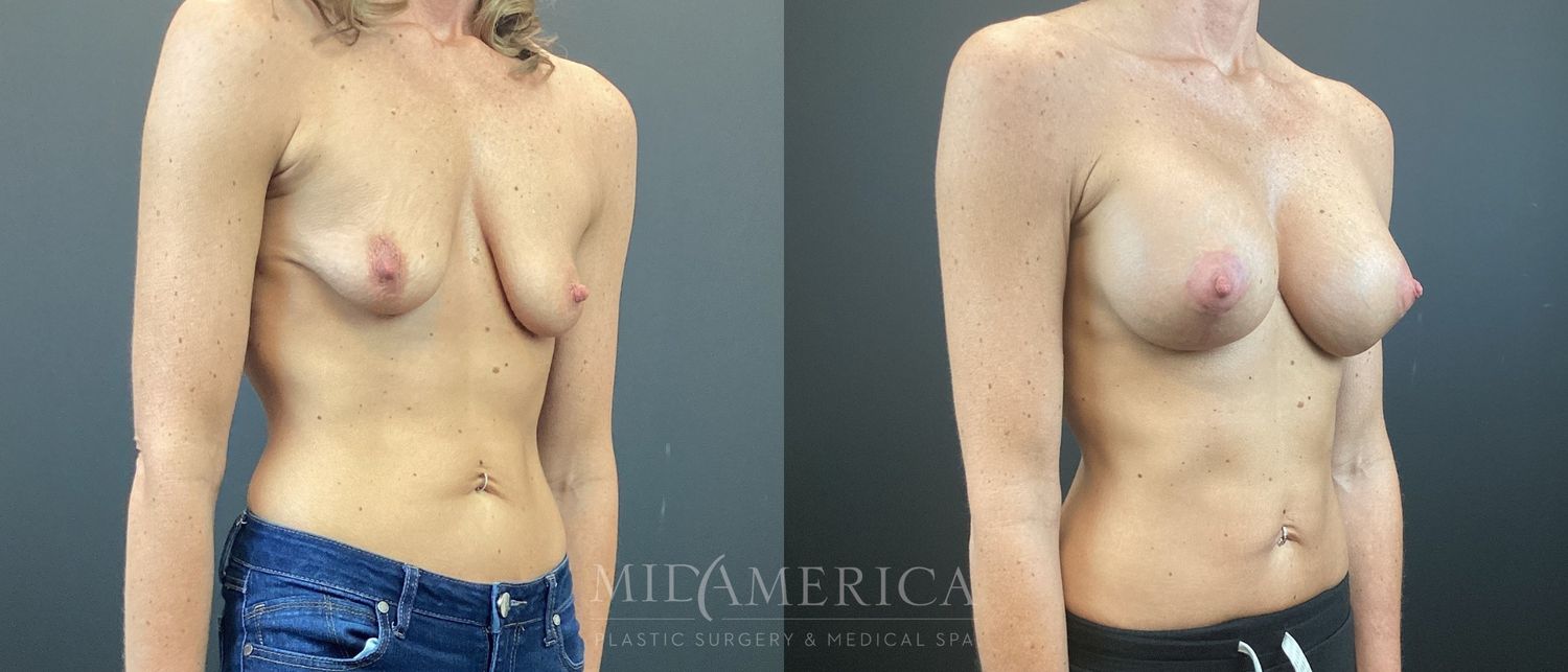Breast Augmentation & Lift Before & After