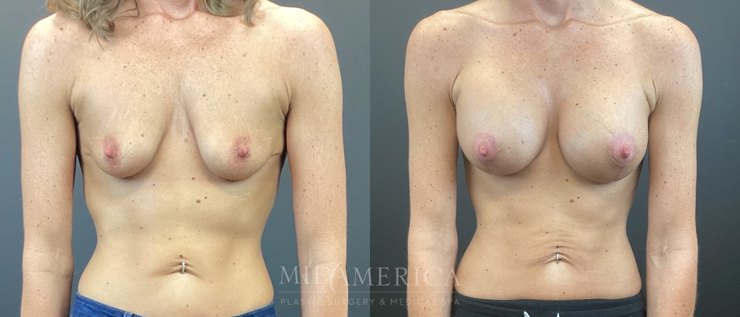 Breast Augmentation & Lift Before & After