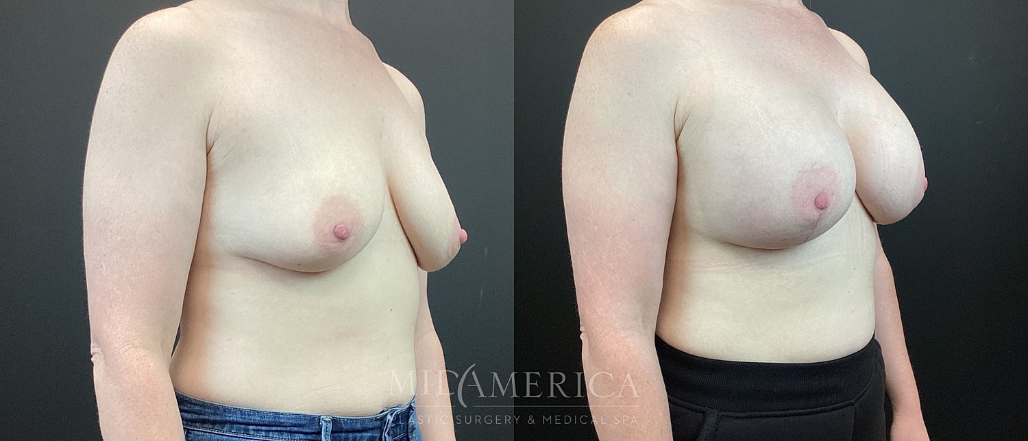 Breast Augmentation & Lift Before & After