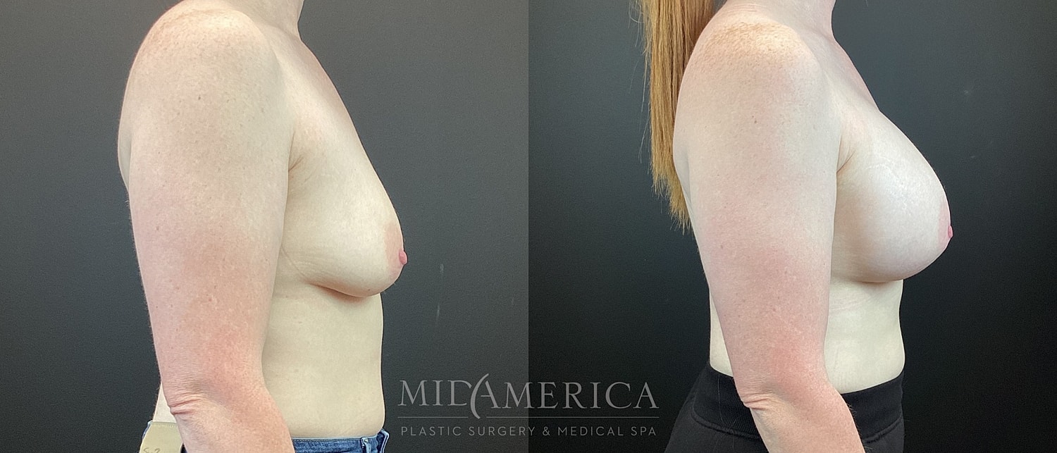 Breast Augmentation & Lift Before & After