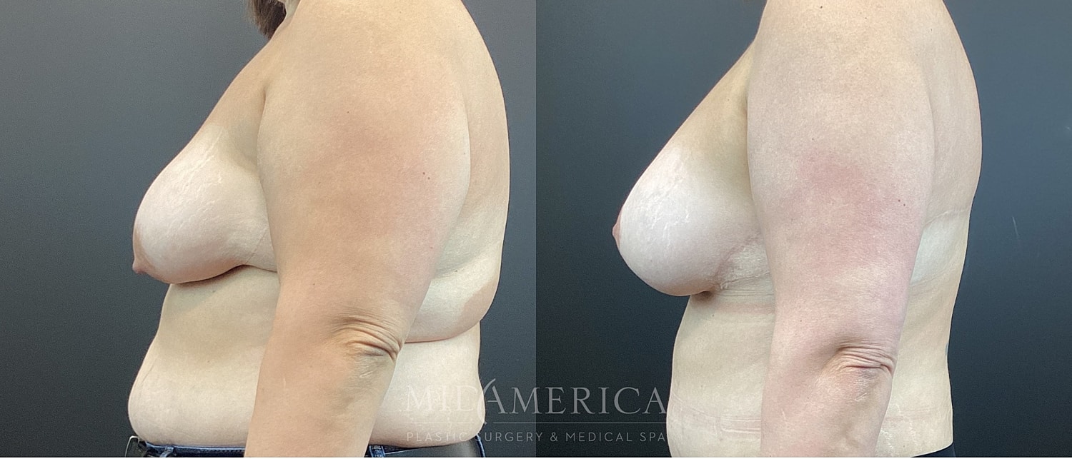 Breast Augmentation & Lift Before & After