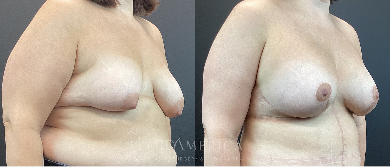 Breast Augmentation & Lift Before & After