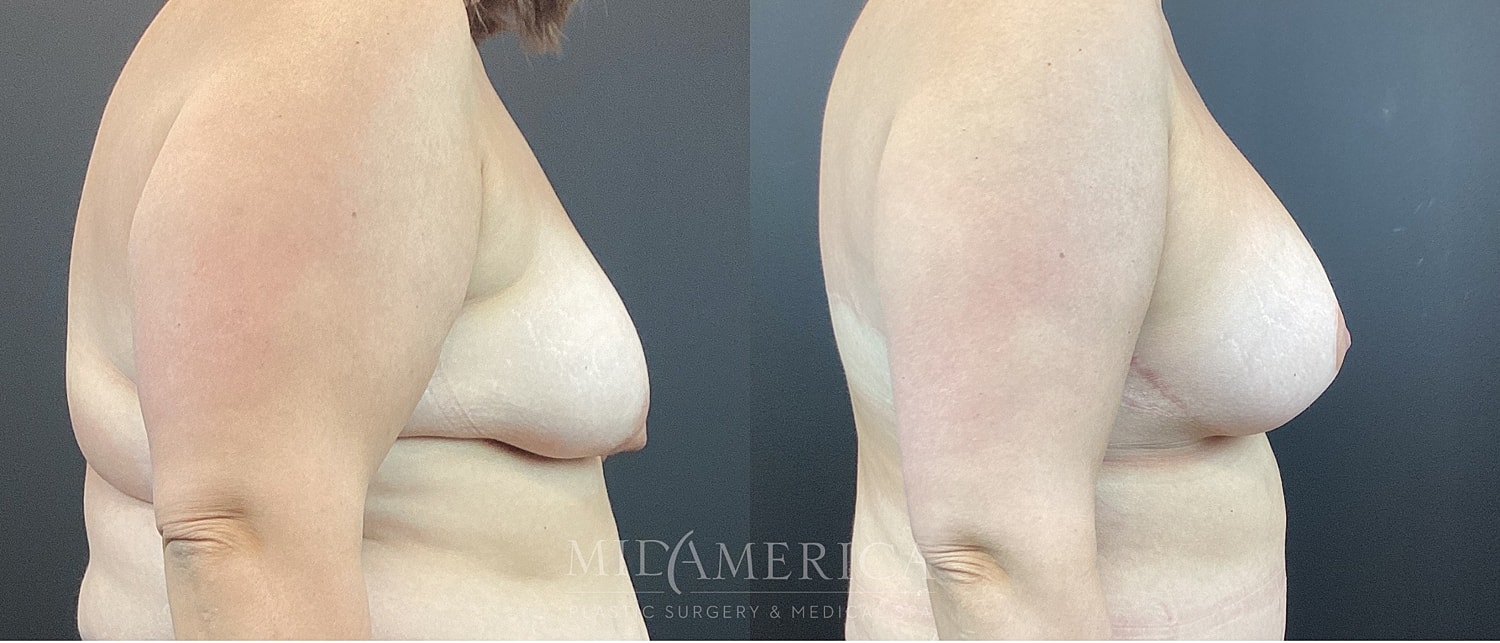 Breast Augmentation & Lift Before & After