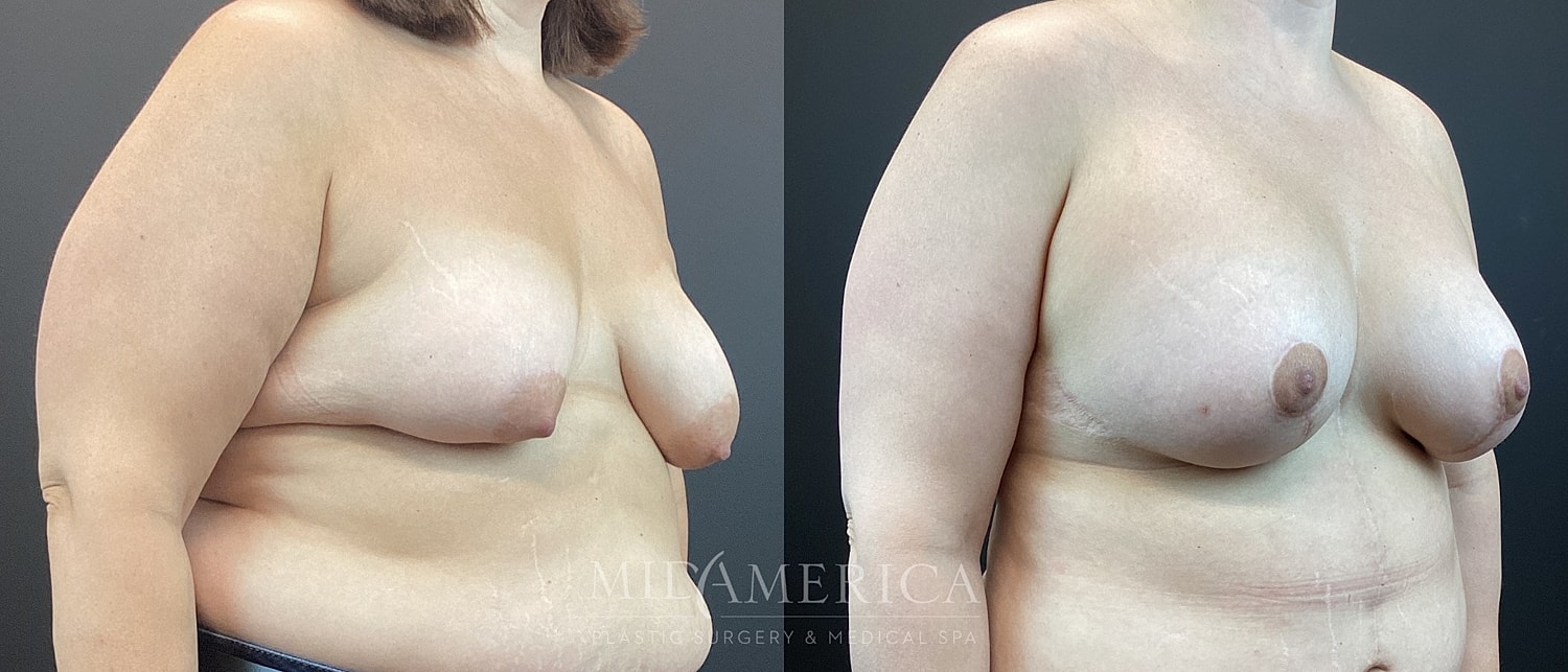 Breast Augmentation & Lift Before & After