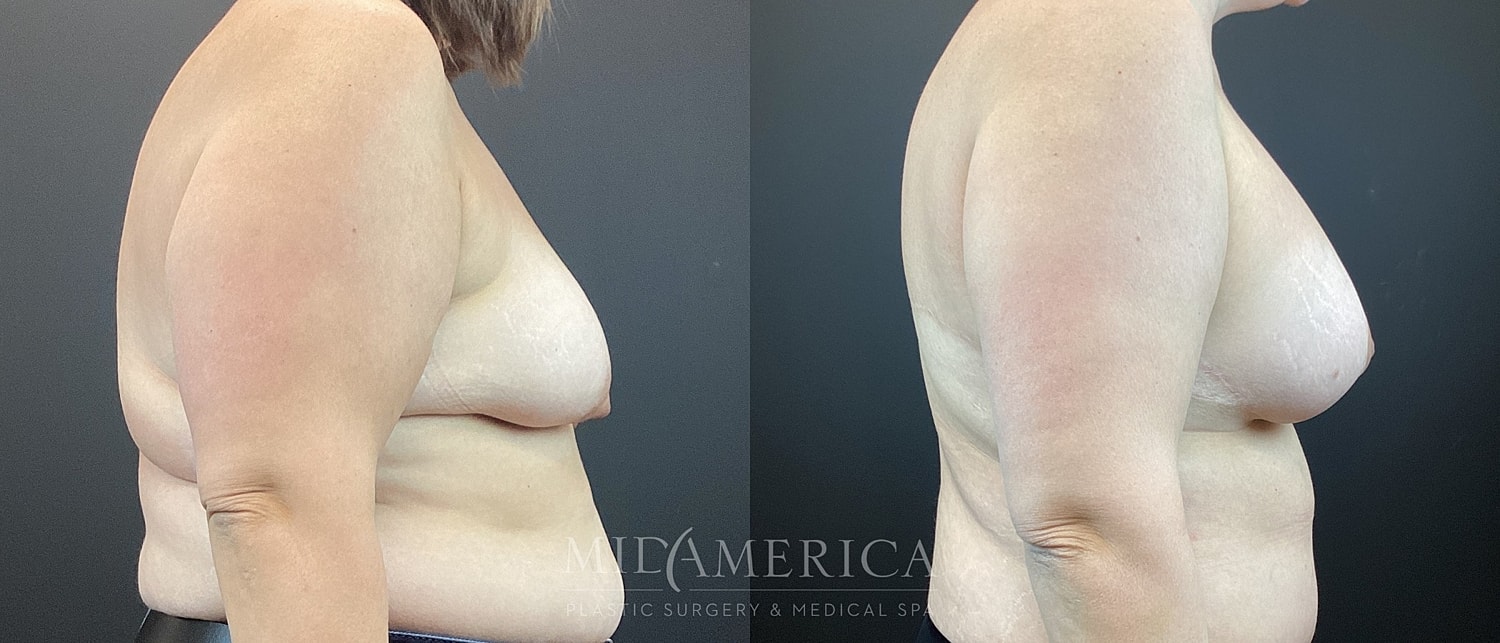 Breast Augmentation & Lift Before & After