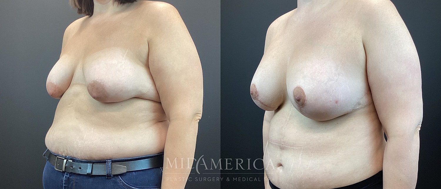 Breast Augmentation & Lift Before & After