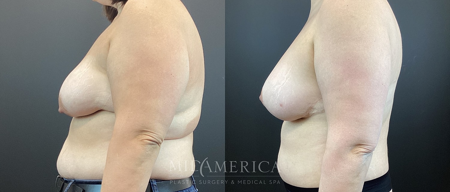 Breast Augmentation & Lift Before & After
