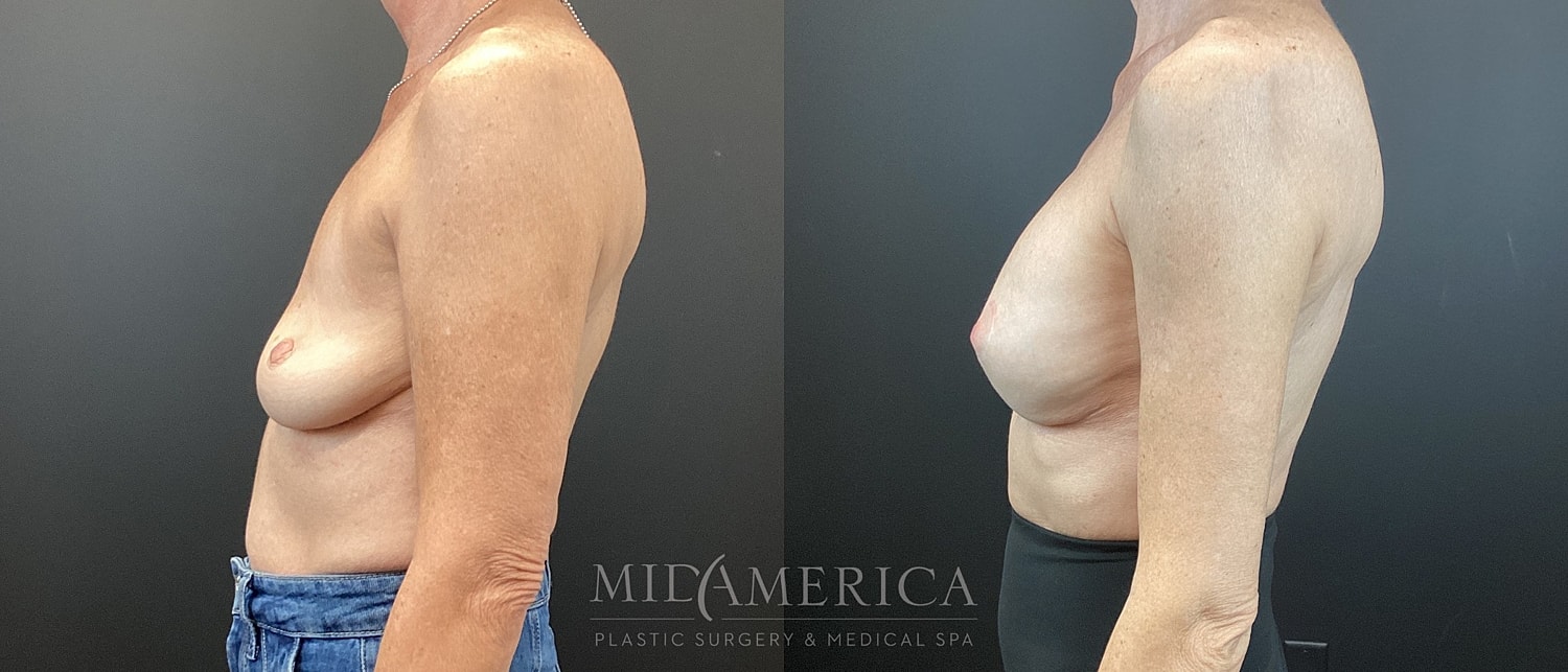 Breast Augmentation & Lift Before & After