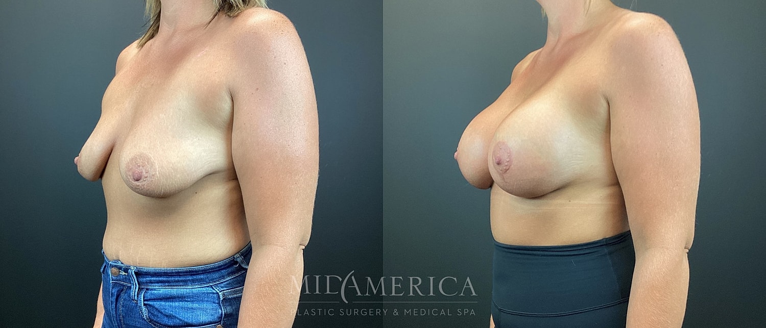 Breast Augmentation & Lift Before & After