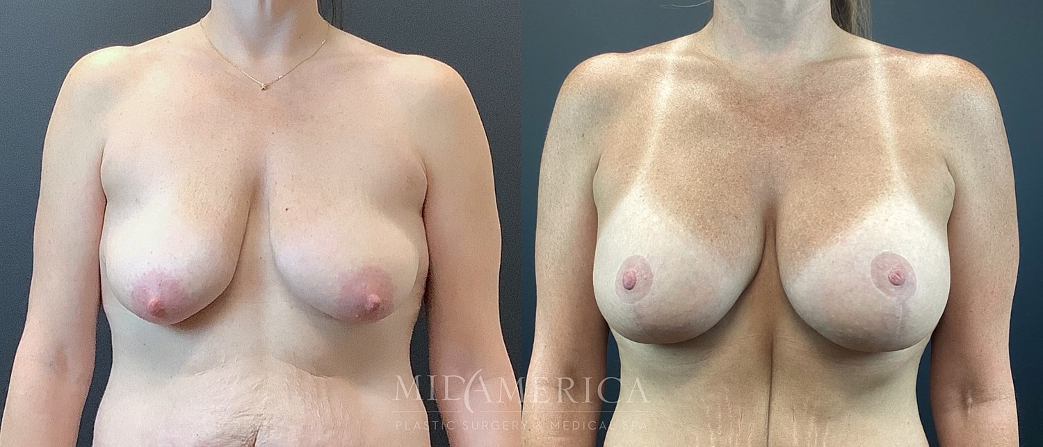 Breast Augmentation & Lift Before & After