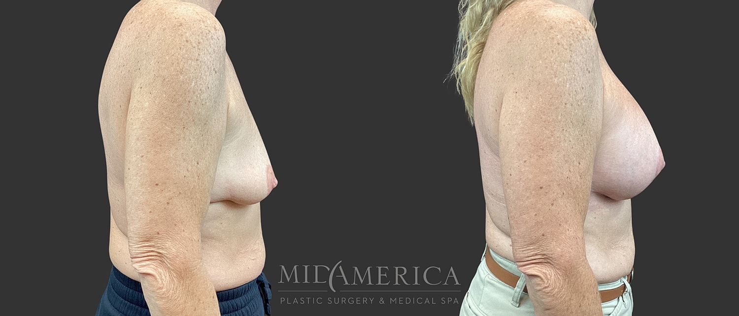 Breast Augmentation & Lift Before & After