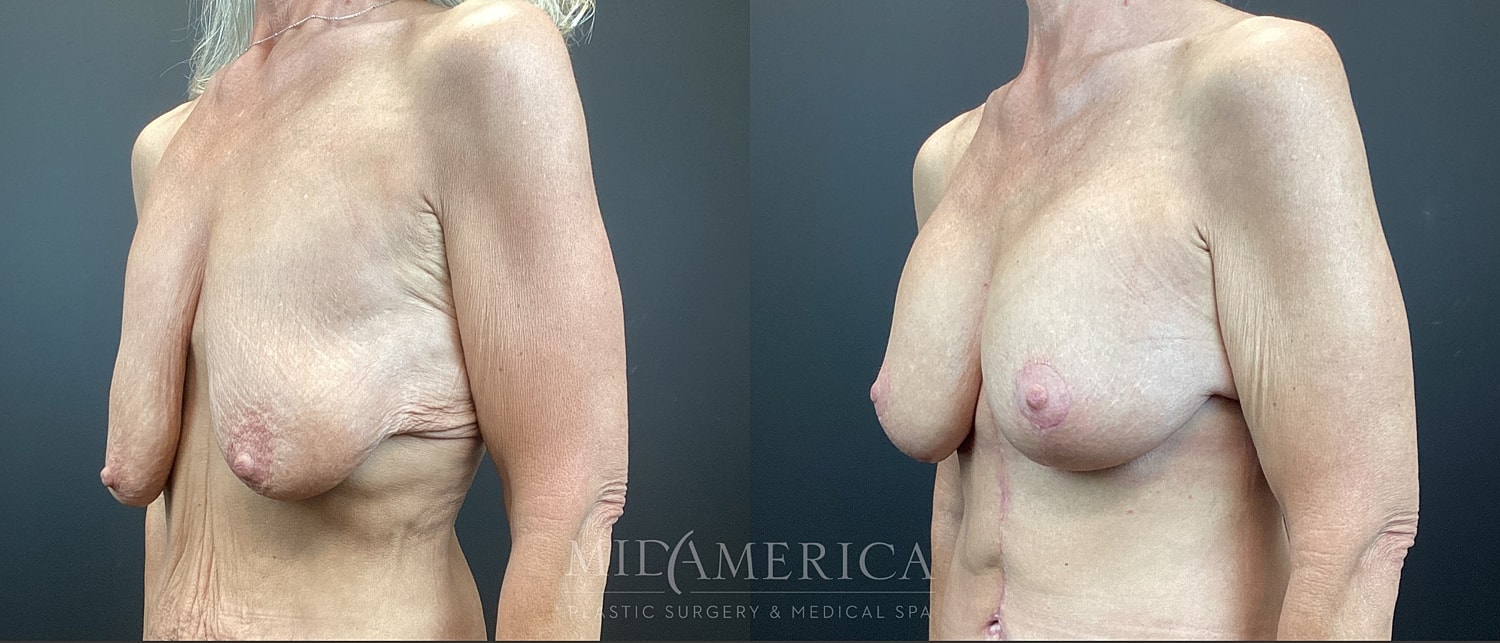 Breast Augmentation & Lift Before & After