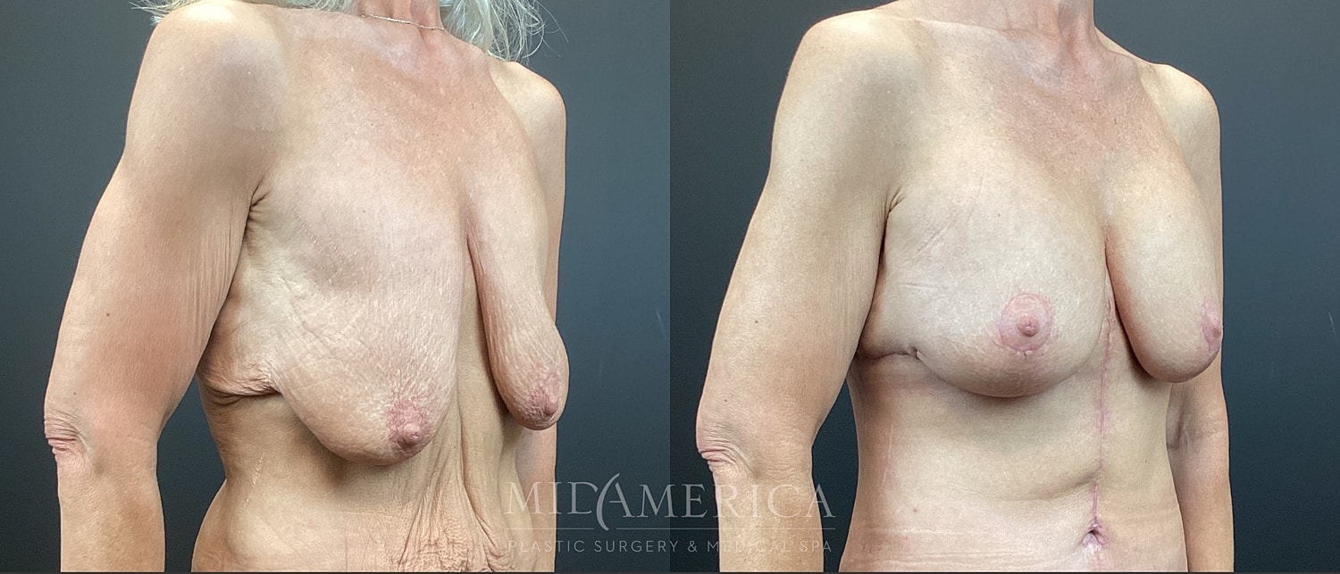 Breast Augmentation & Lift Before & After