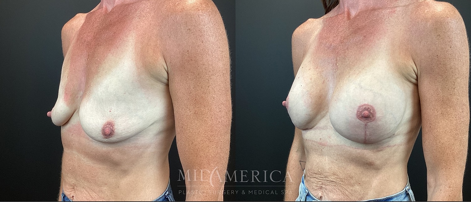 Breast Augmentation & Lift Before & After