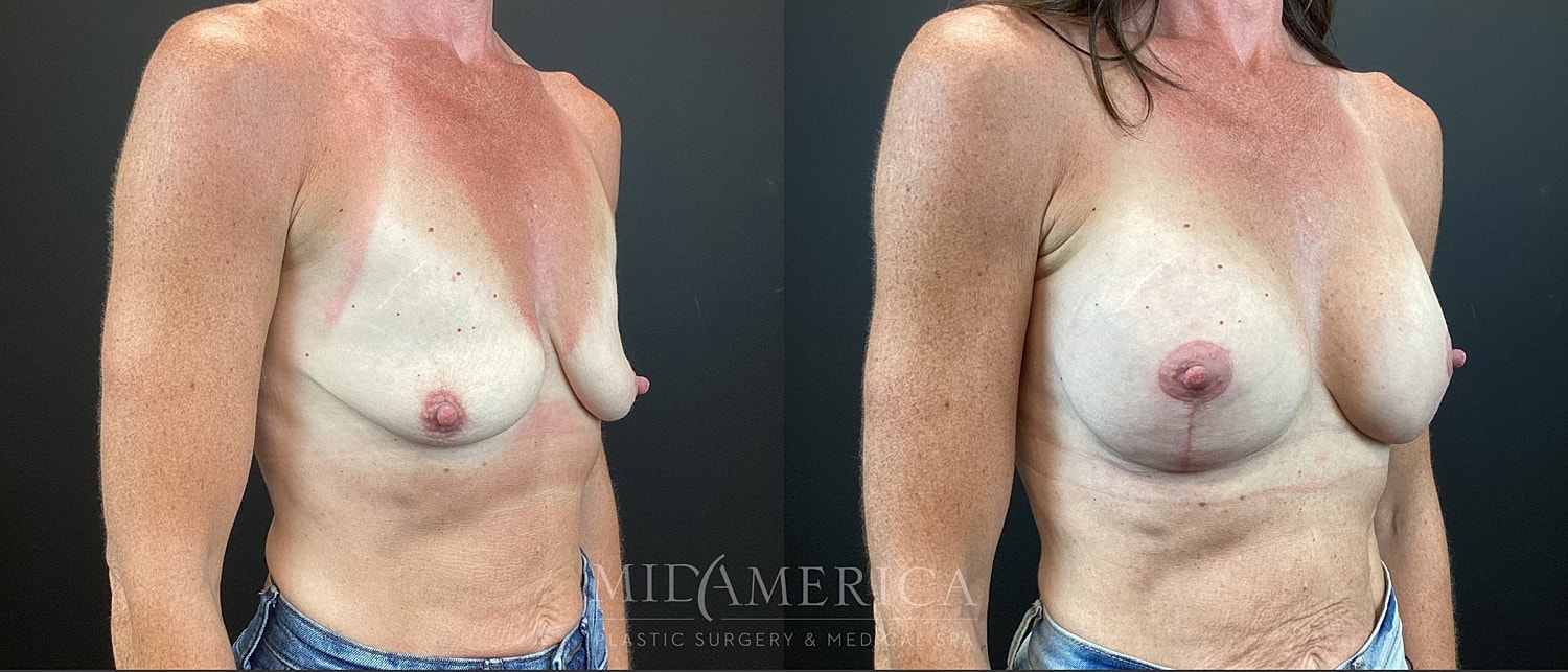 Breast Augmentation & Lift Before & After