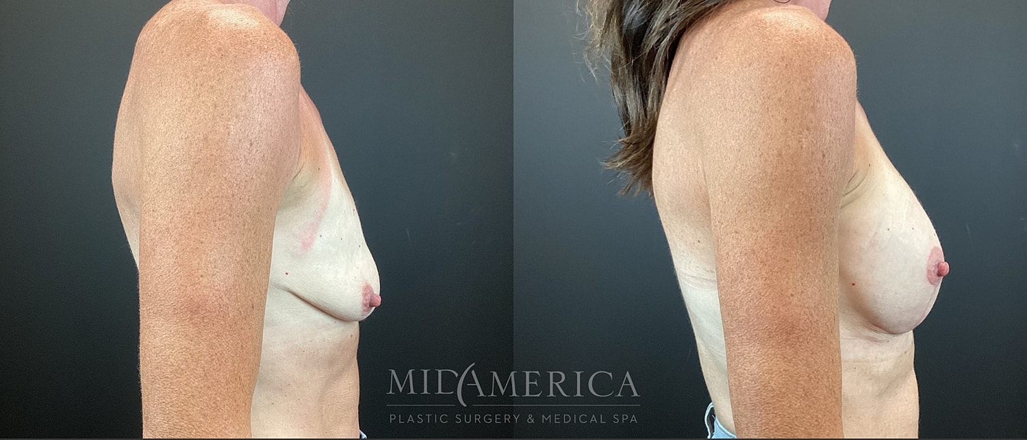 Breast Augmentation & Lift Before & After