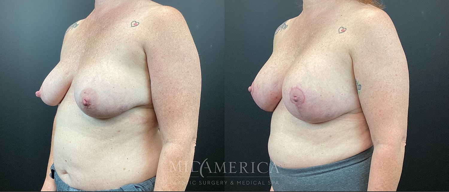 Breast Augmentation & Lift Before & After