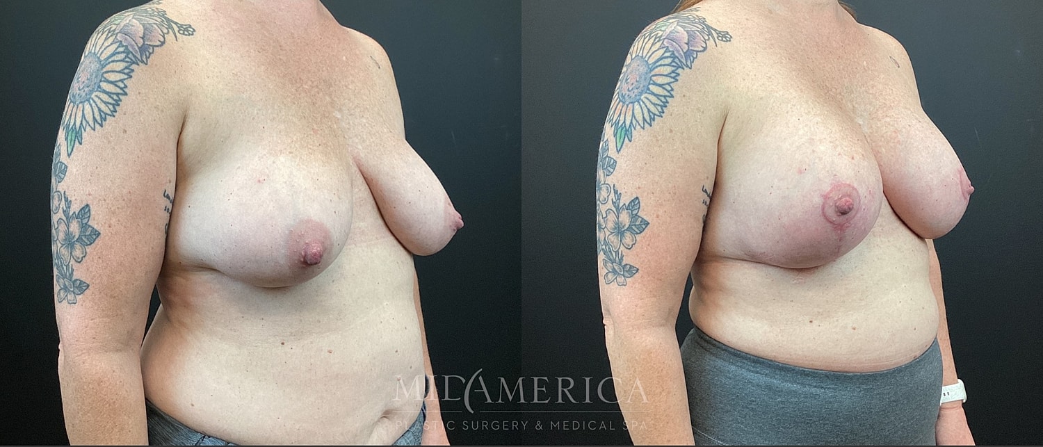 Breast Augmentation & Lift Before & After