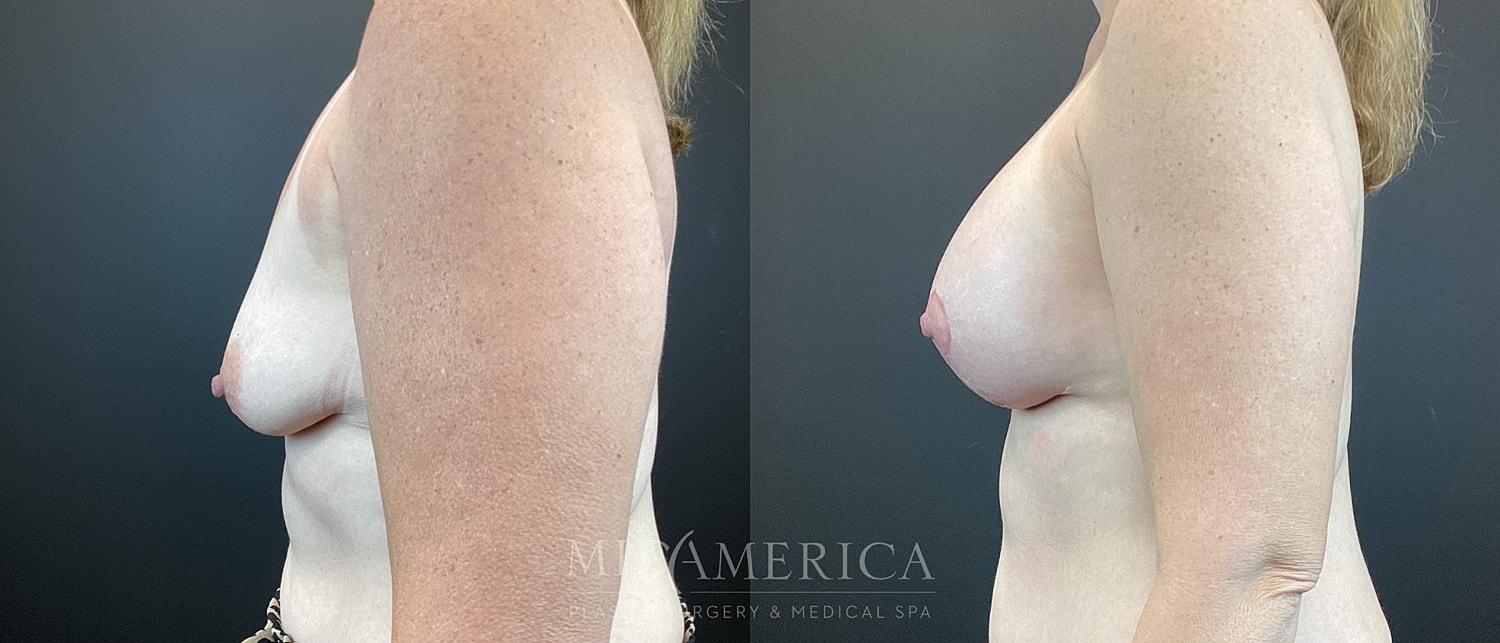 Breast Augmentation & Lift Before & After
