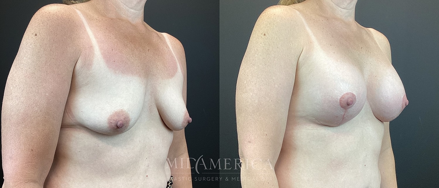 Breast Augmentation & Lift Before & After