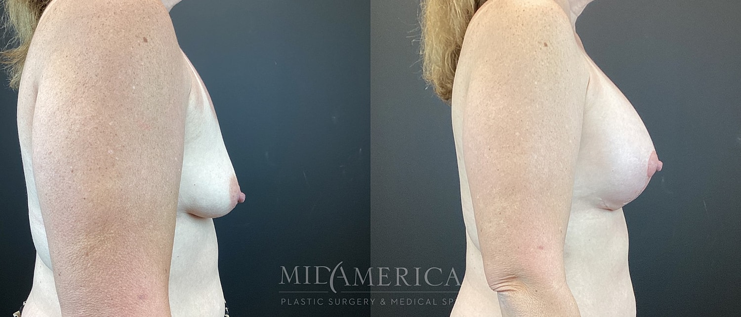 Breast Augmentation & Lift Before & After