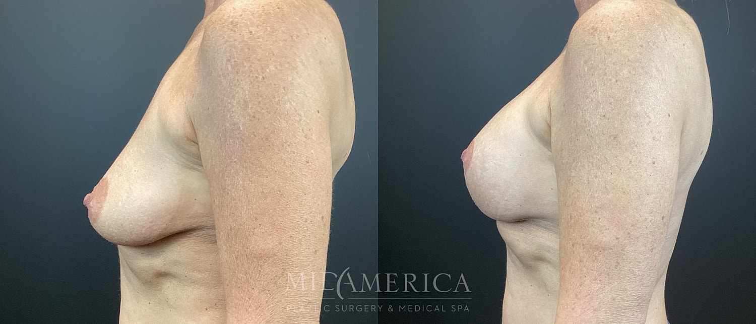 Breast Augmentation & Lift Before & After