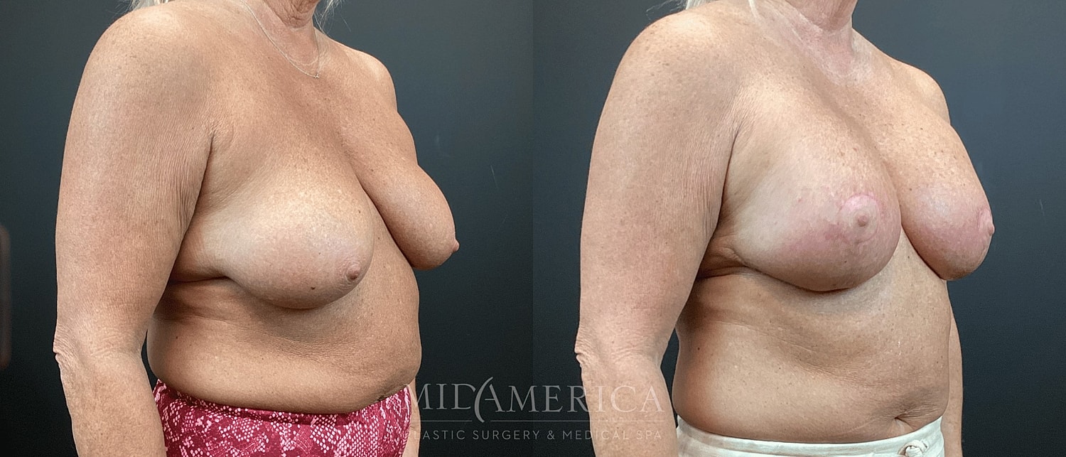 Breast Augmentation & Lift Before & After