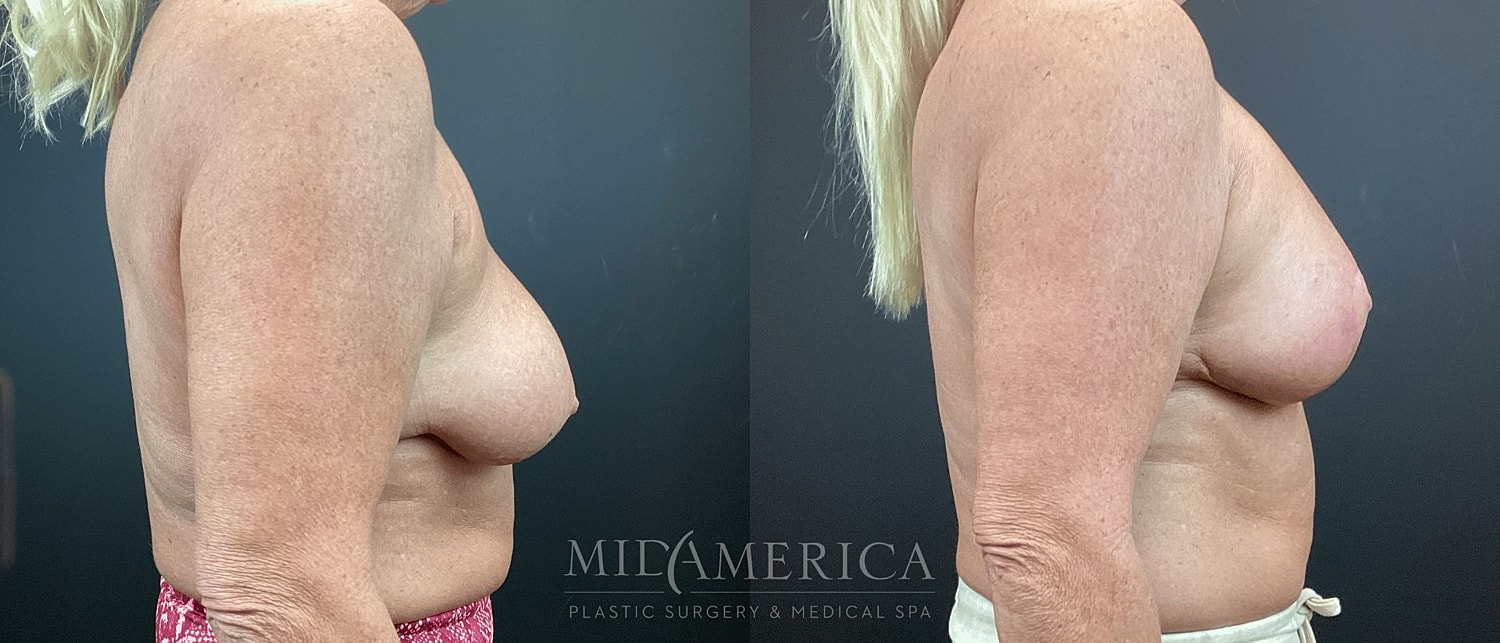 Breast Augmentation & Lift Before & After