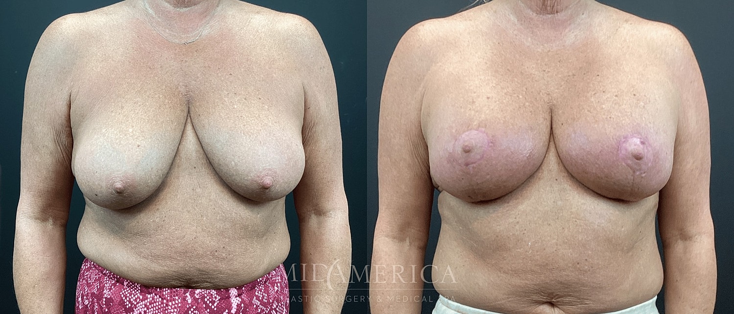 Breast Augmentation & Lift Before & After